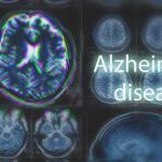 MRI brain scan highlighting Alzheimer's disease