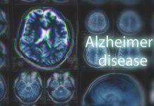 MRI brain scan highlighting Alzheimer's disease