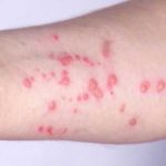 MONKEYPOX Outbreak Hits Pride Month