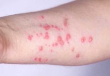 MONKEYPOX Outbreak Hits Pride Month