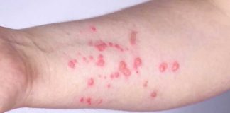MONKEYPOX Outbreak Hits Pride Month MONKEYPOX Outbreak Hits Pride Month